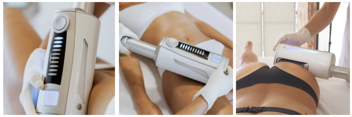 cellulite-therapie